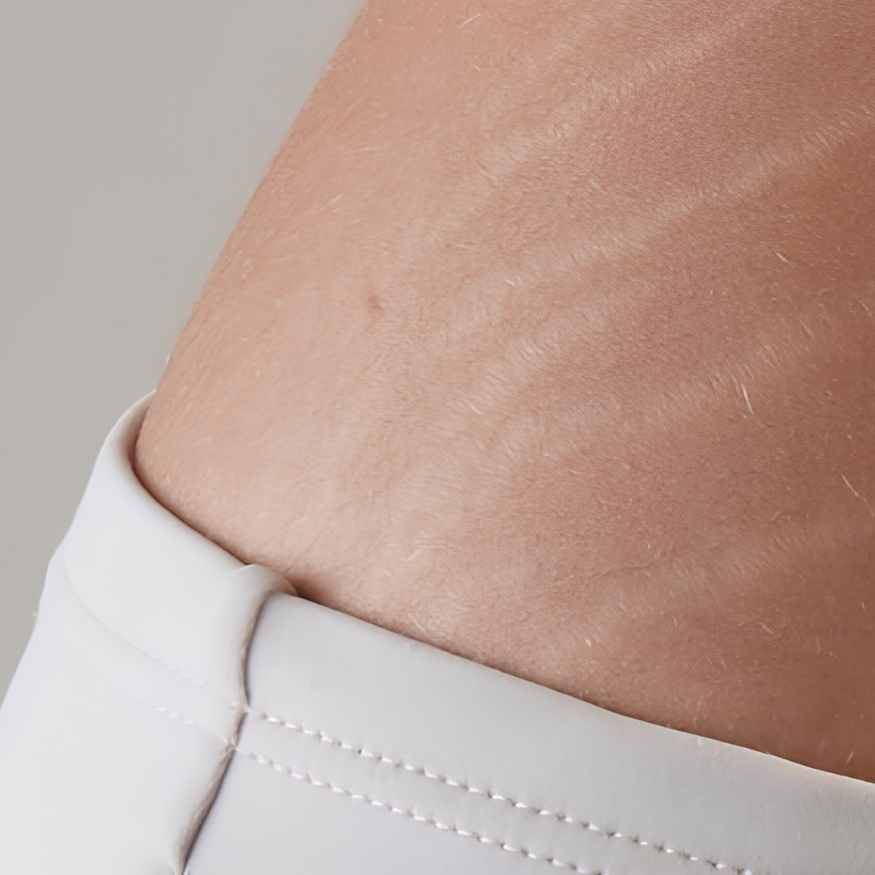 Stretch Mark, Kenapa Muncul?