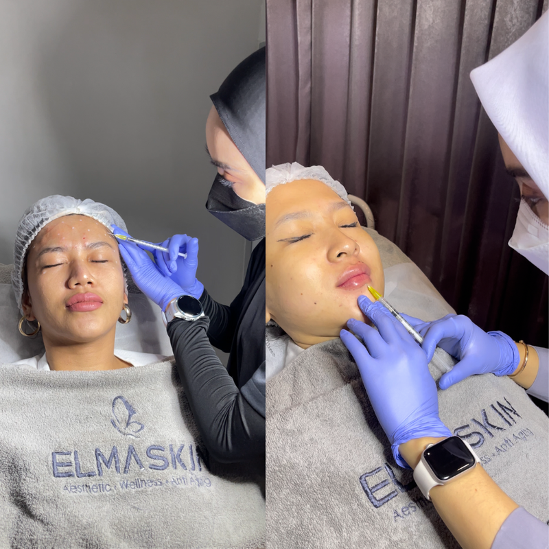 Botox vs Filler: Apa Bedanya dan Kapan Sebaiknya Dipilih?