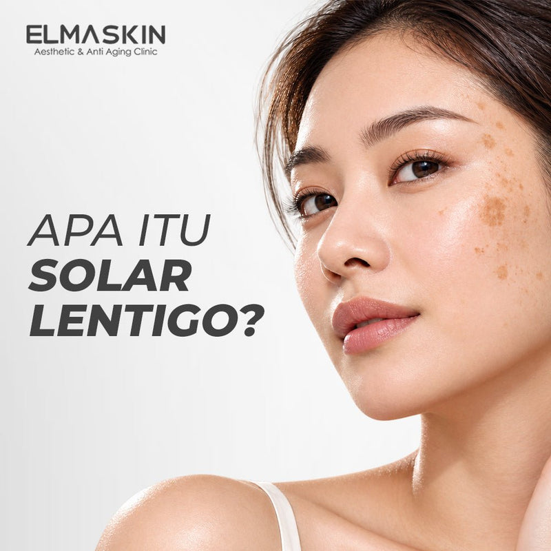 Apa itu Solar Lentigo? Kenali Penyebab hingga Cara Mengatasinya - elmaskin.id