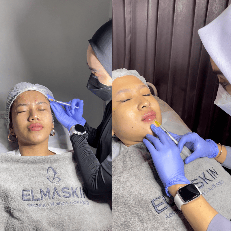 Botox vs Filler: Apa Bedanya dan Kapan Sebaiknya Dipilih? - elmaskin.id