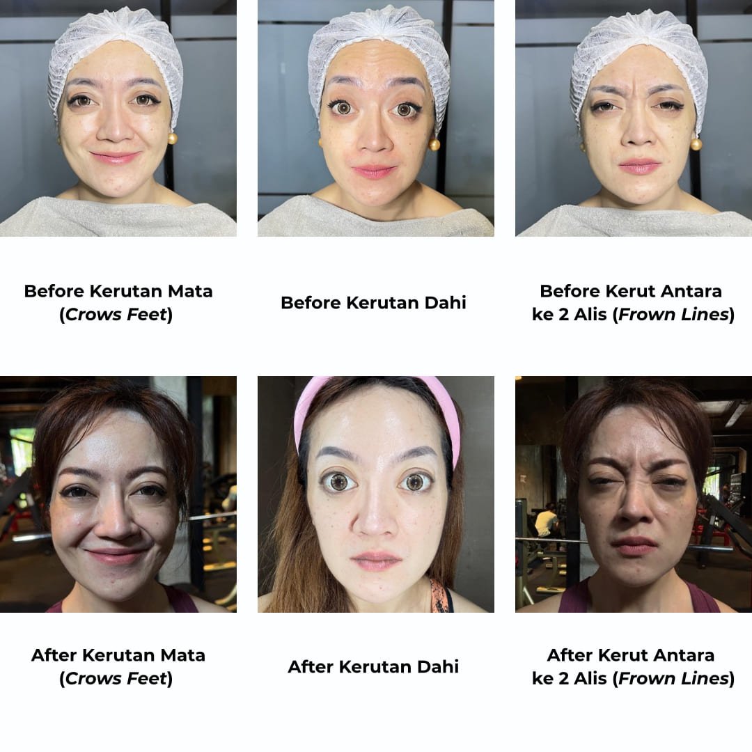 Hasil Botox dalam Menghilangkan Kerutan - elmaskin.id