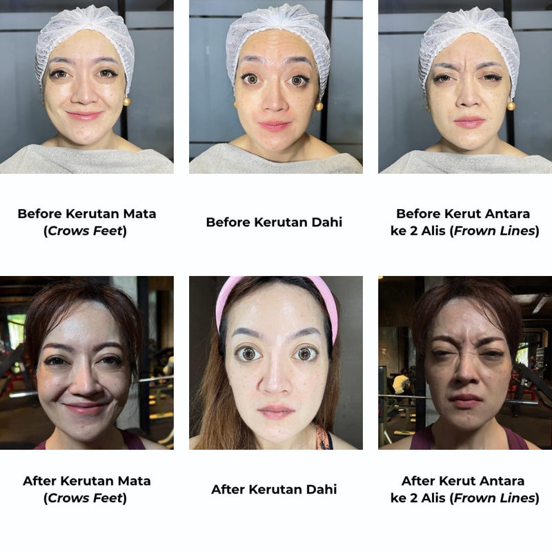 Hasil Botox dalam Menghilangkan Kerutan - elmaskin.id