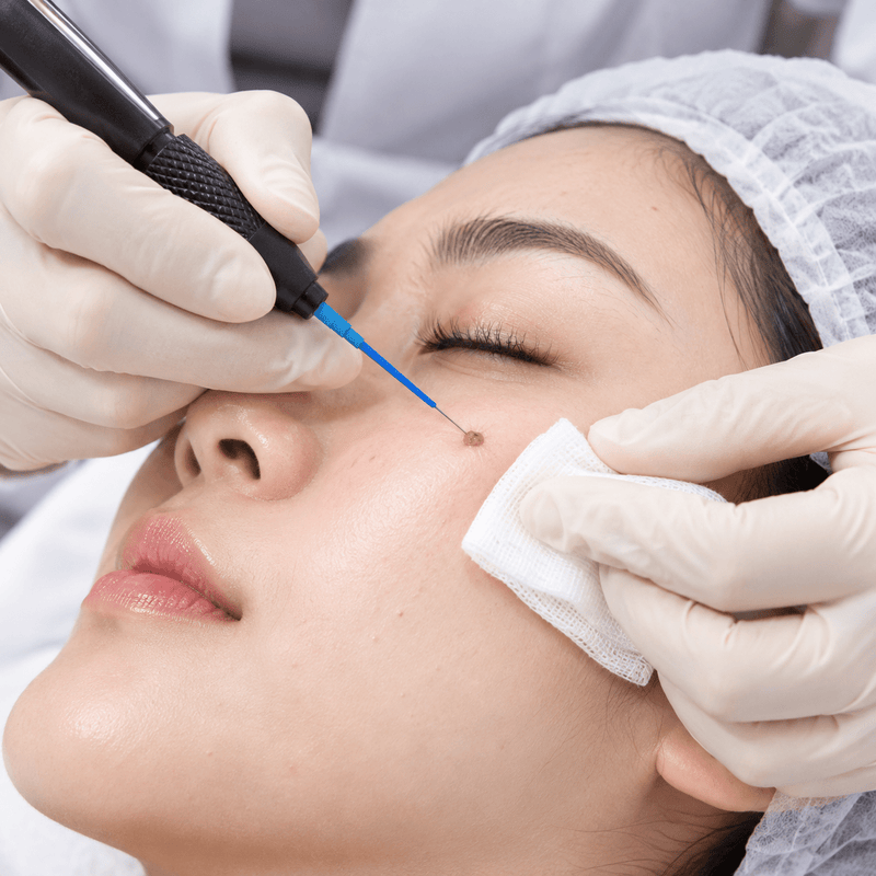 Mengenal Electrocauter: Solusi Praktis untuk Skin Tag, Milia, dan Benjolan Kulit Jinak - elmaskin.id